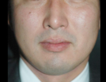 施術後