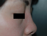 ヒアルロン酸による隆鼻（鼻背に注入）後
