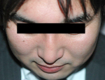 ショッピングスレッド施術