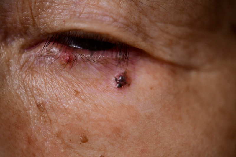 目の周り、目の上、目の下のほくろ除去 症例