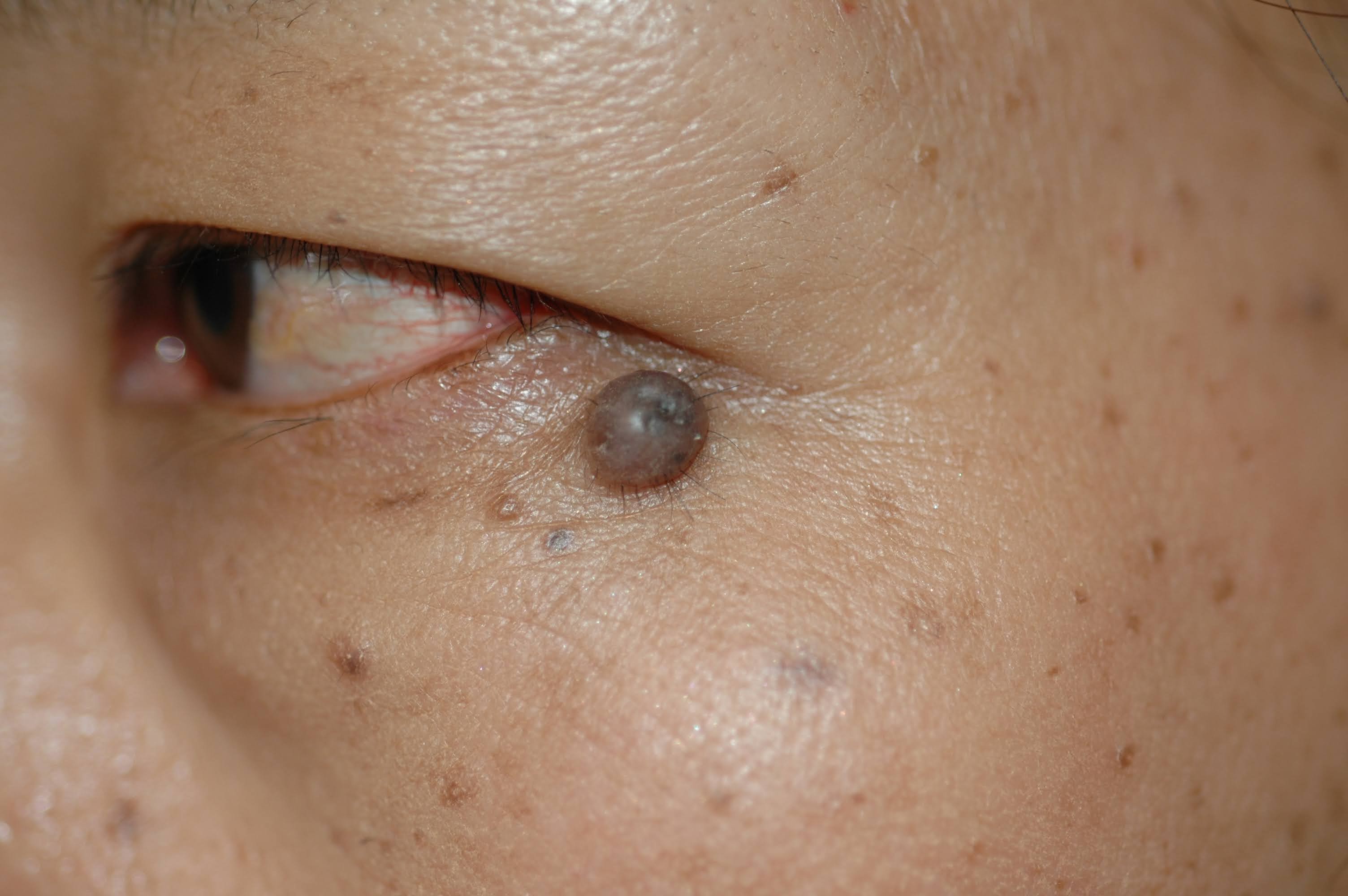 目の周り、目の上、目の下のほくろ除去 症例