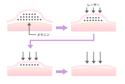 スーパーパルスCO2レーザー