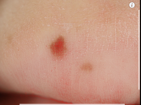 血管反映画像では、ホクロに赤くしっかり血管が見られますが、シミには血管が認められません。
