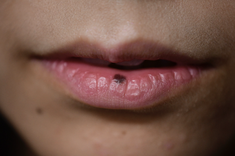 下口唇の中央にはっきりとした黒褐色、ほぼ円形の色素斑が観察できます。