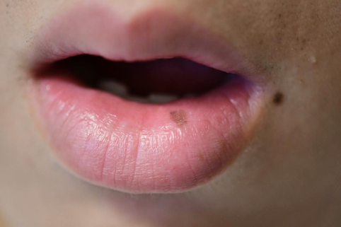 下口唇にある境界明瞭な淡褐色のシミです。