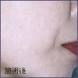 施術後