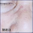 施術後