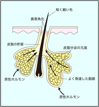 脂腺性毛包