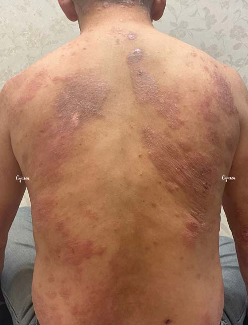 新薬のJAK阻害剤であるリンヴォックを投与