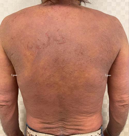 新薬のJAK阻害剤であるリンヴォックを投与