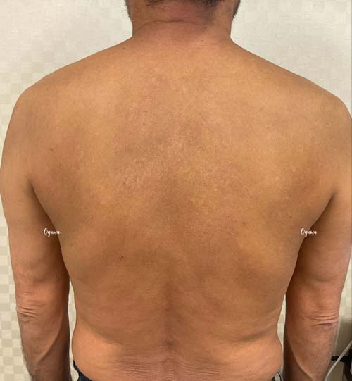 新薬のJAK阻害剤であるリンヴォックを投与