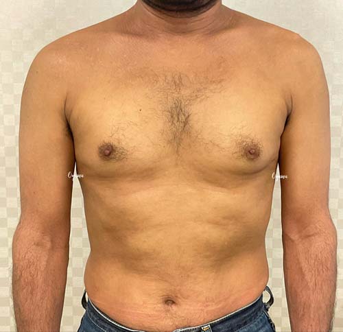 新薬のJAK阻害剤であるリンヴォックを投与