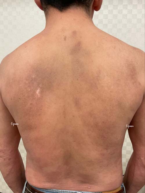 新薬のJAK阻害剤であるリンヴォックを投与