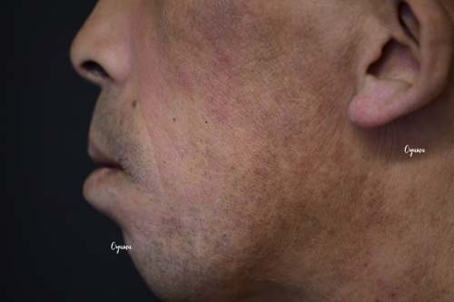 新薬のJAK阻害剤であるリンヴォックを投与