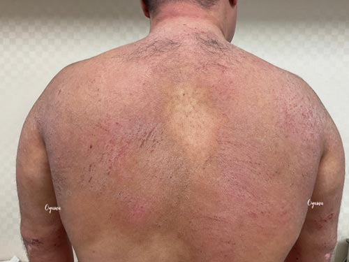 新薬のJAK阻害剤であるリンヴォックを投与