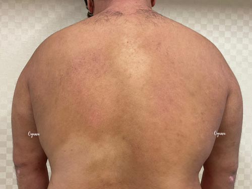 新薬のJAK阻害剤であるリンヴォックを投与
