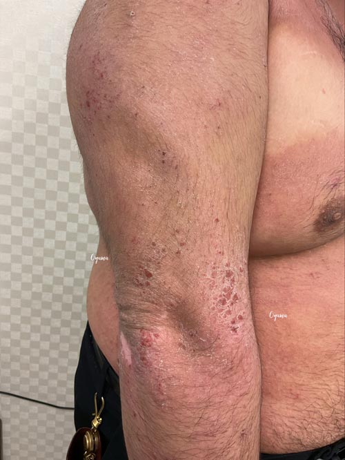 新薬のJAK阻害剤であるリンヴォックを投与