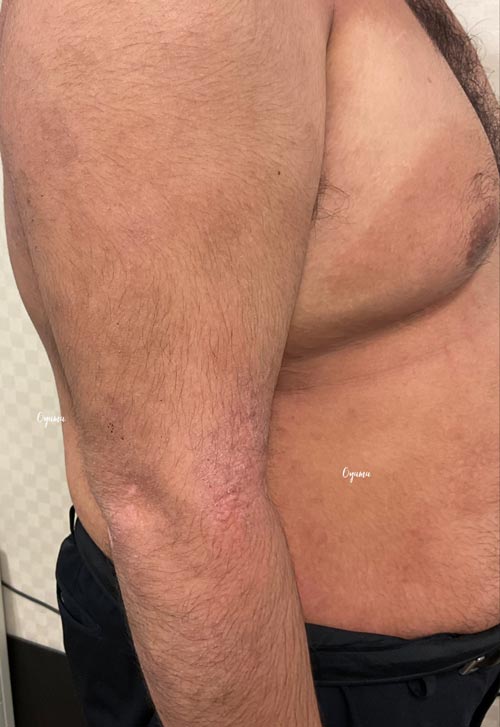 新薬のJAK阻害剤であるリンヴォックを投与