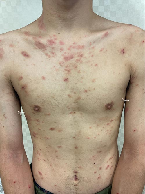 新薬のJAK阻害剤であるリンヴォックを投与
