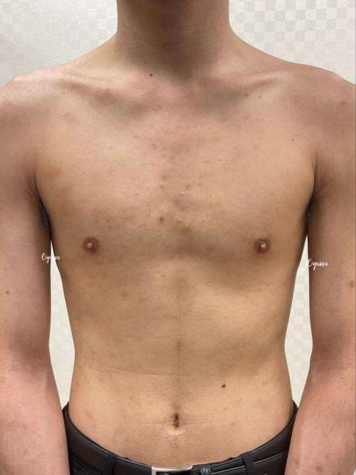 新薬のJAK阻害剤であるリンヴォックを投与
