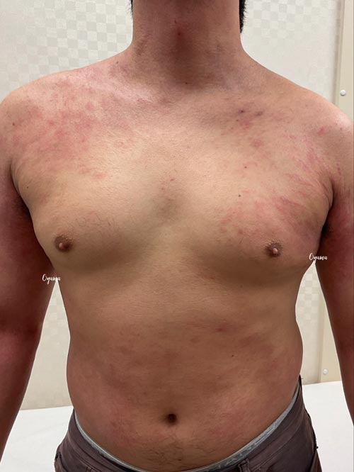 新薬のJAK阻害剤であるリンヴォックを投与