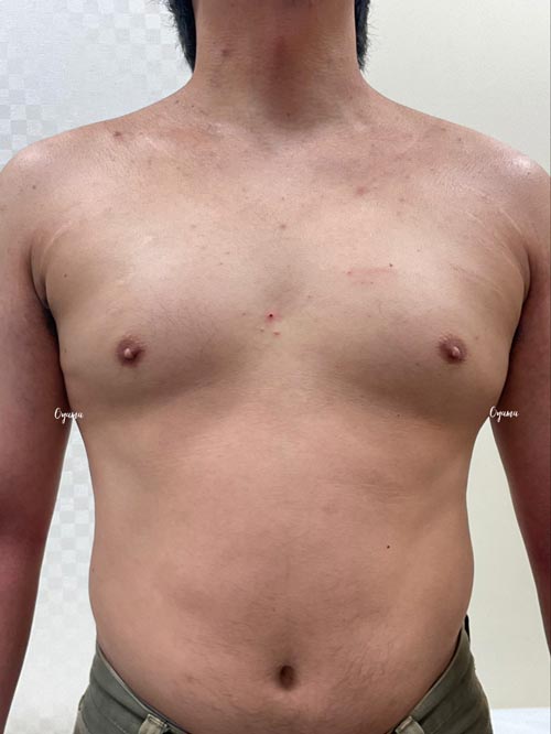 新薬のJAK阻害剤であるリンヴォックを投与