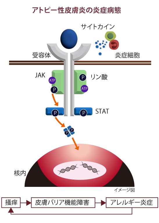 アトピー性皮膚炎の炎症病態