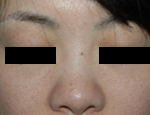 ヒアルロン酸による隆鼻（鼻背に注入）前