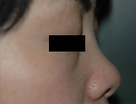 ヒアルロン酸による隆鼻（鼻背に注入）前