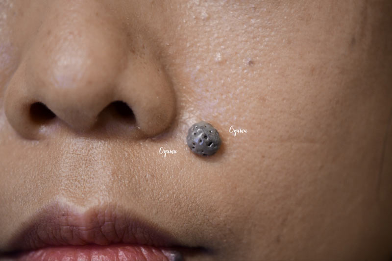 通常のほくろの境界