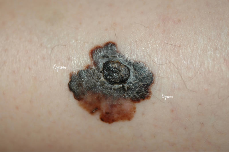 悪性黒色腫(メラノーマ)ABCDEが揃っている例