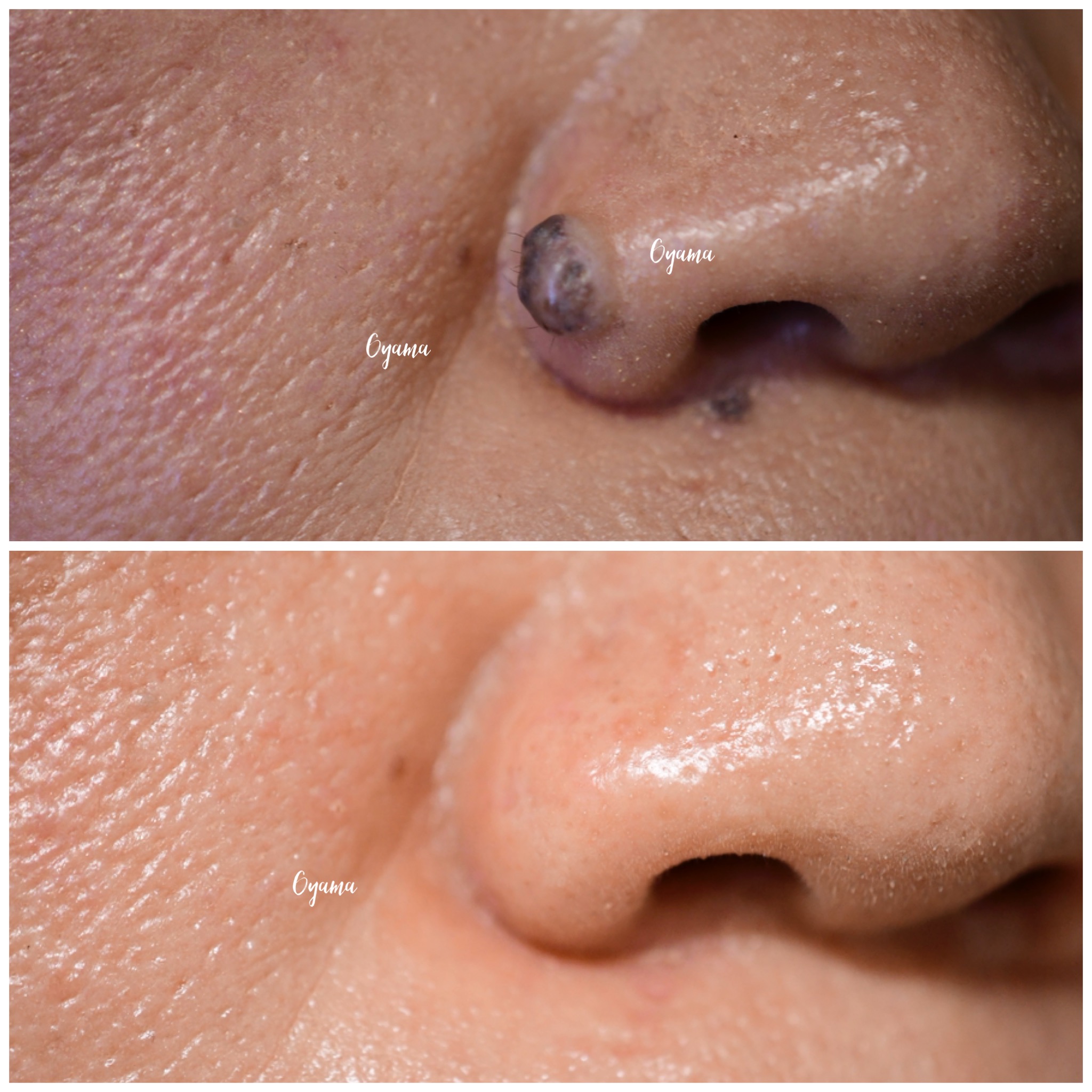 大きいほくろ除去