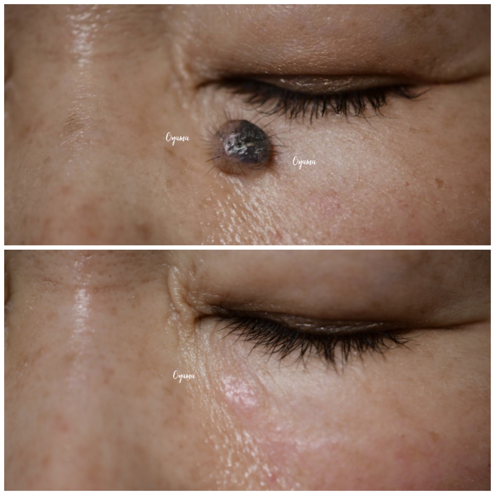 大きいほくろ除去