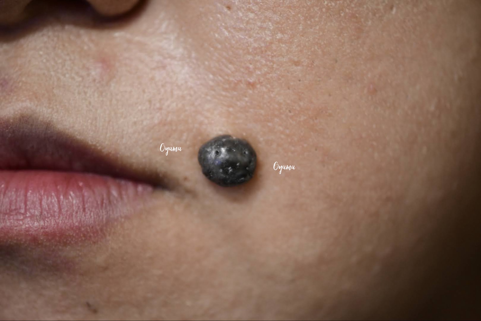 大きいほくろ除去