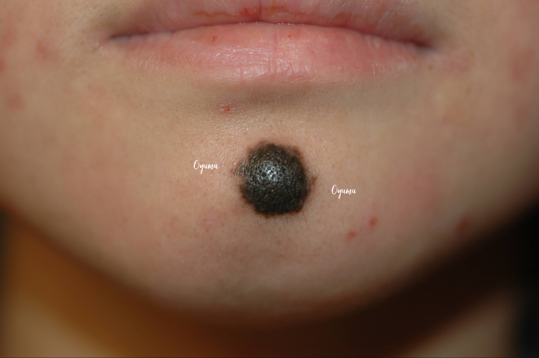 大きいほくろ除去