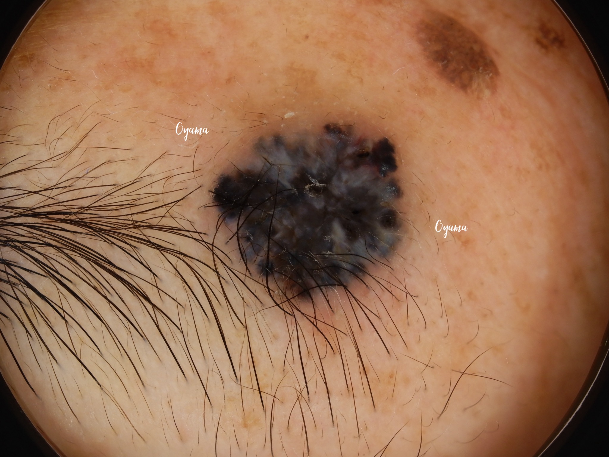 大きいほくろ除去