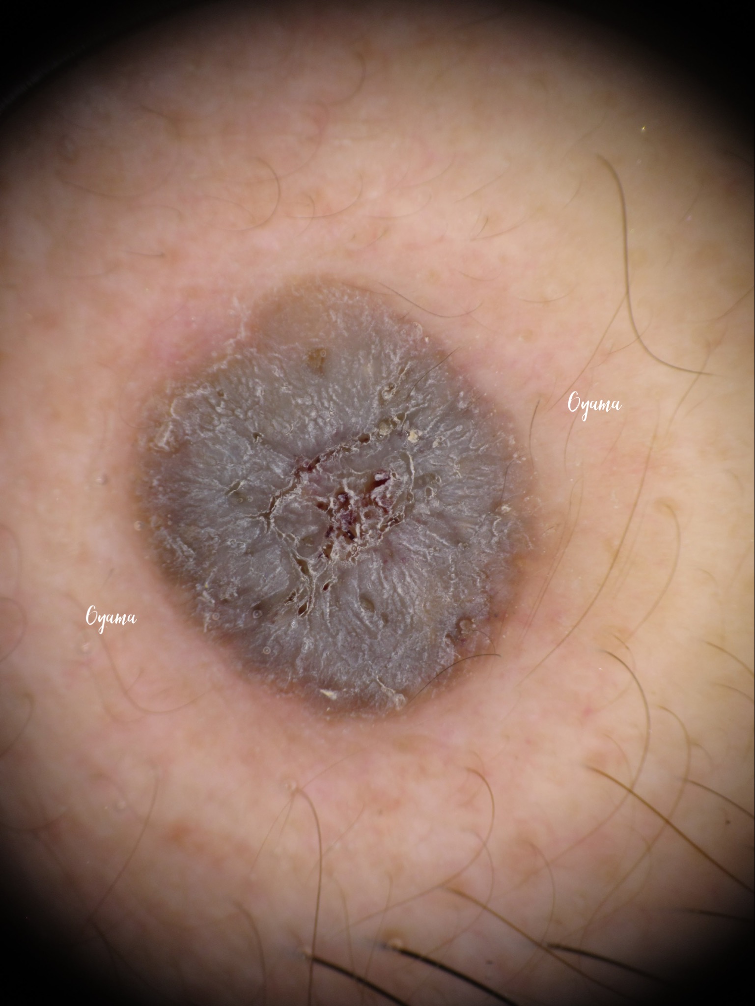 大きいほくろ除去