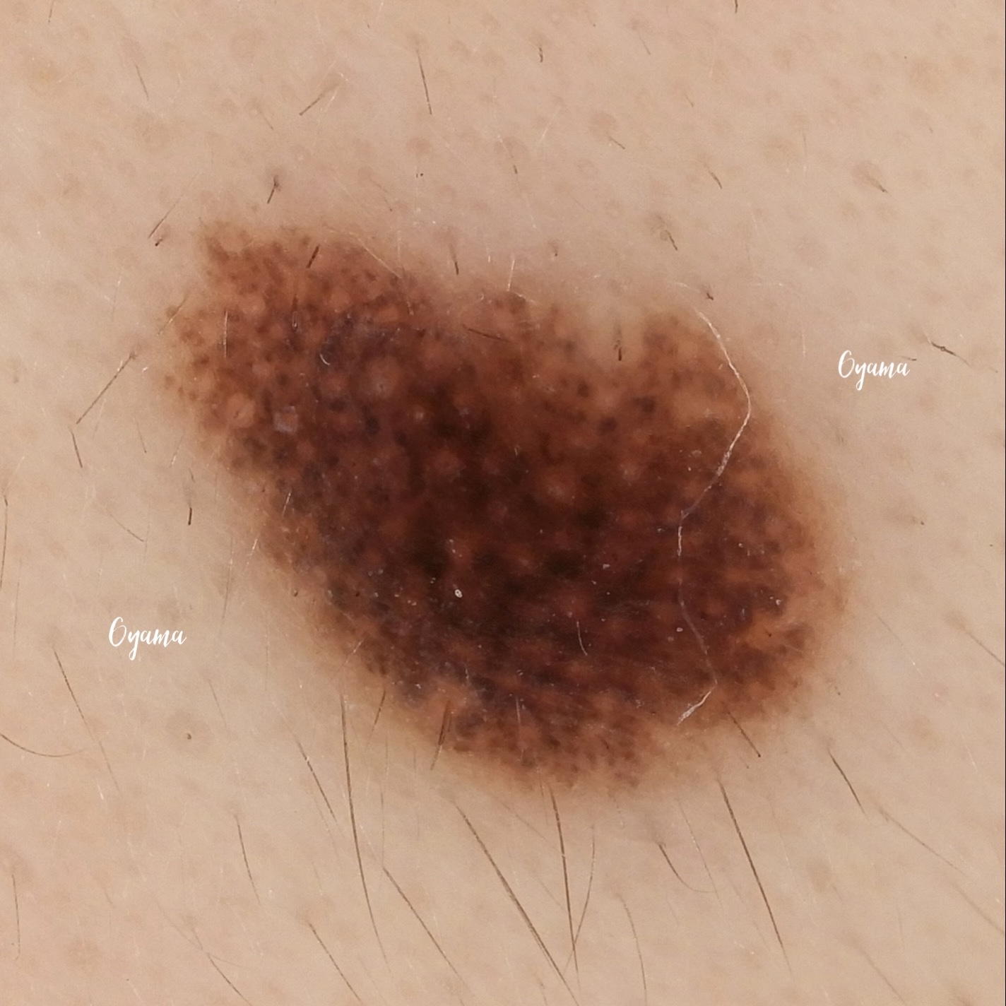 大きいほくろ除去