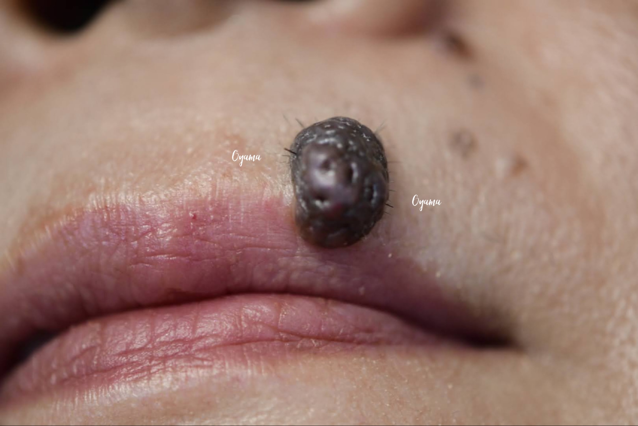 大きいほくろ除去