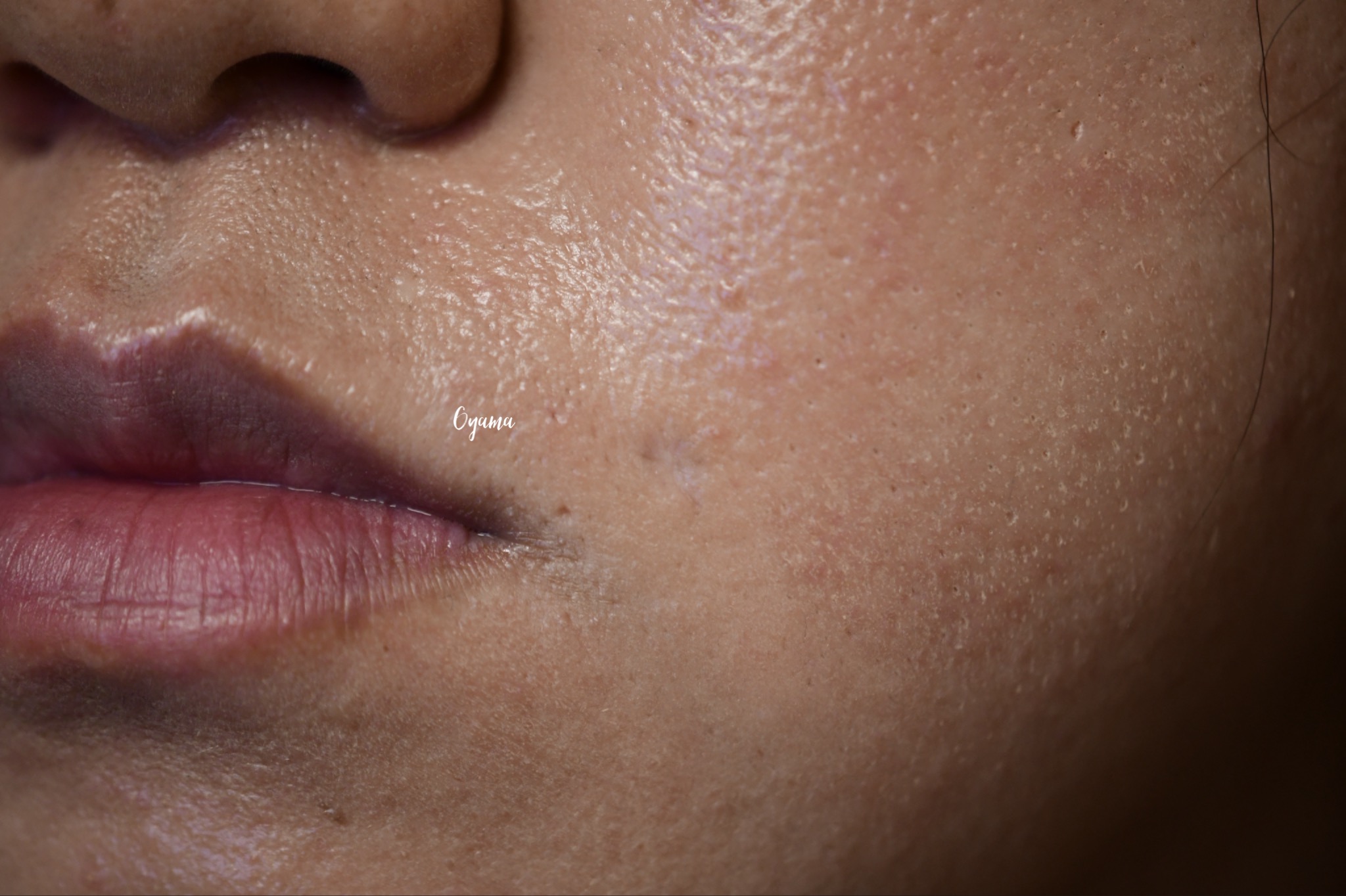 大きいほくろ除去