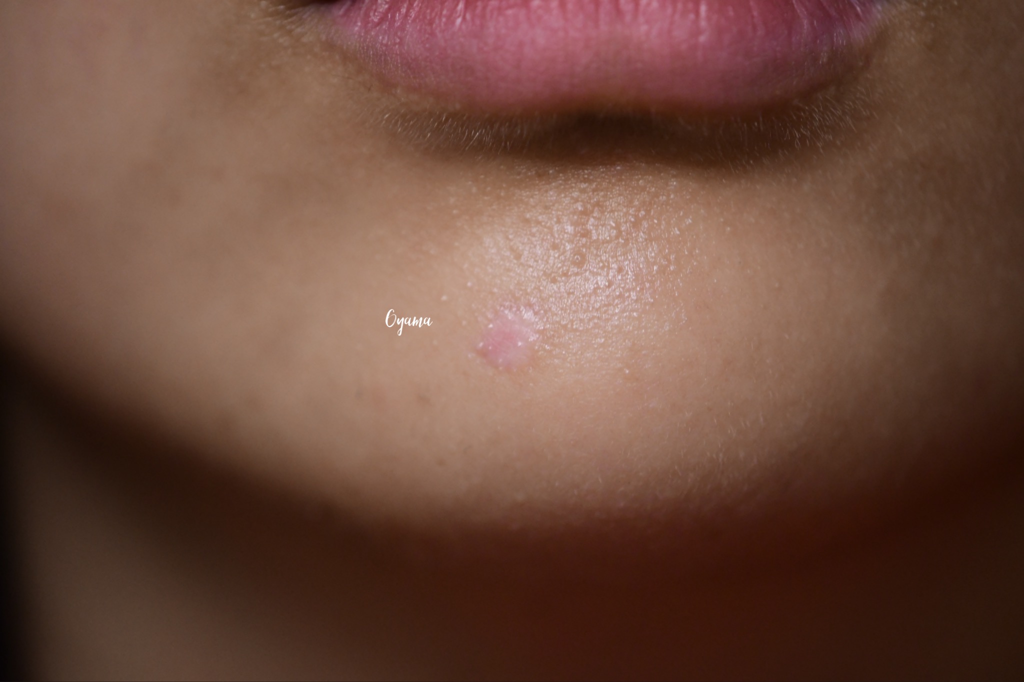 大きいほくろ除去