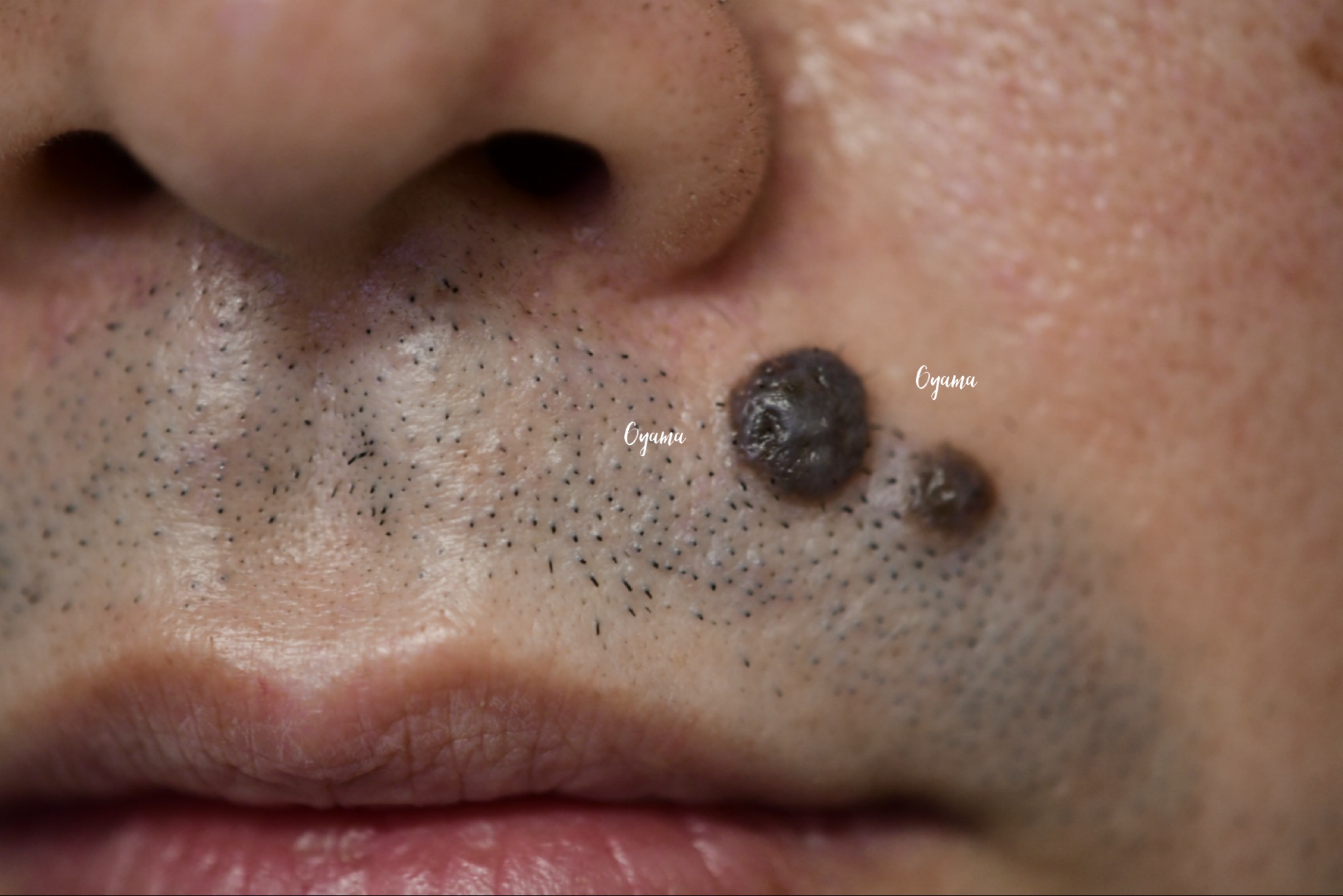 大きいほくろ除去