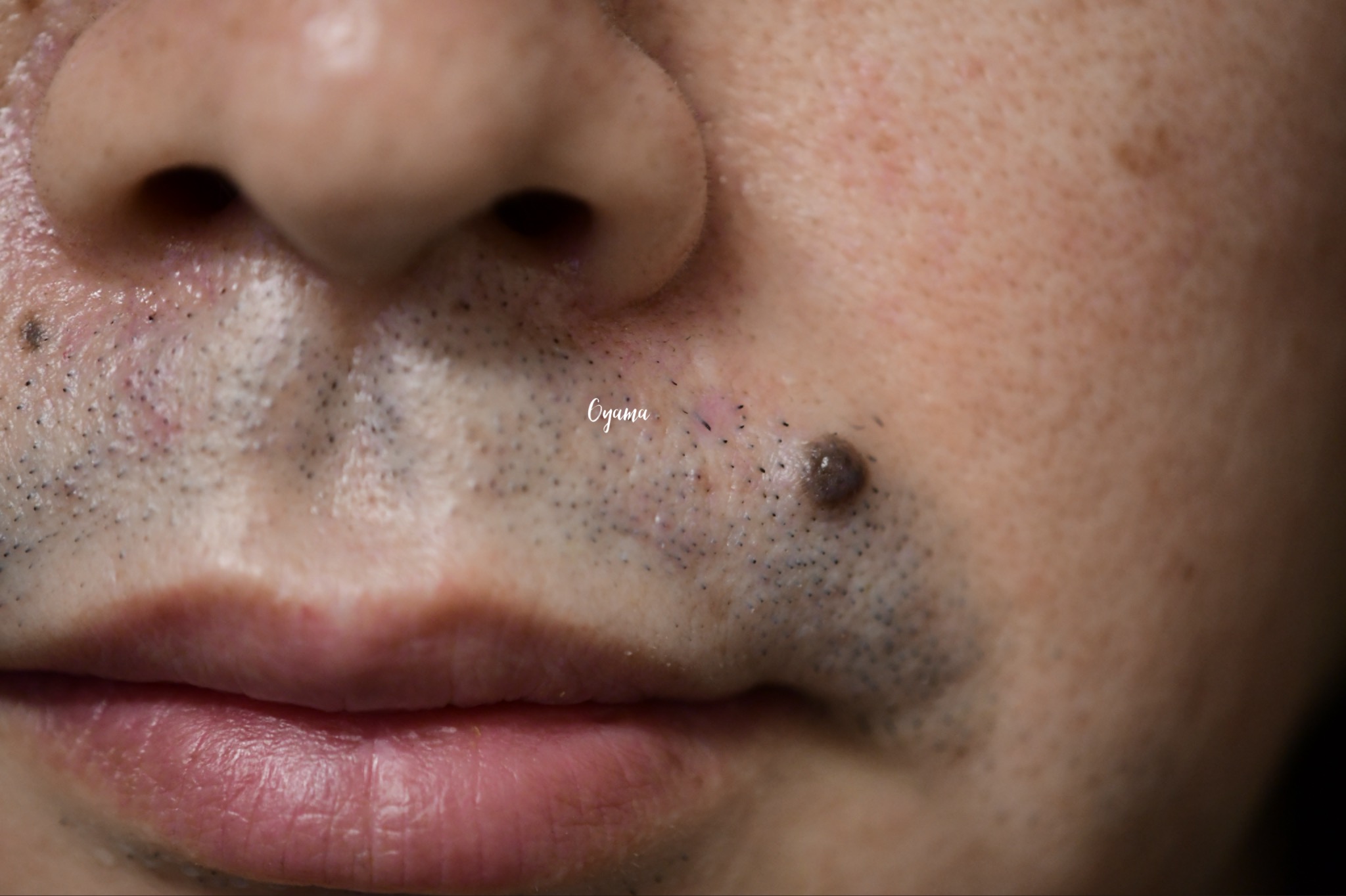 大きいほくろ除去