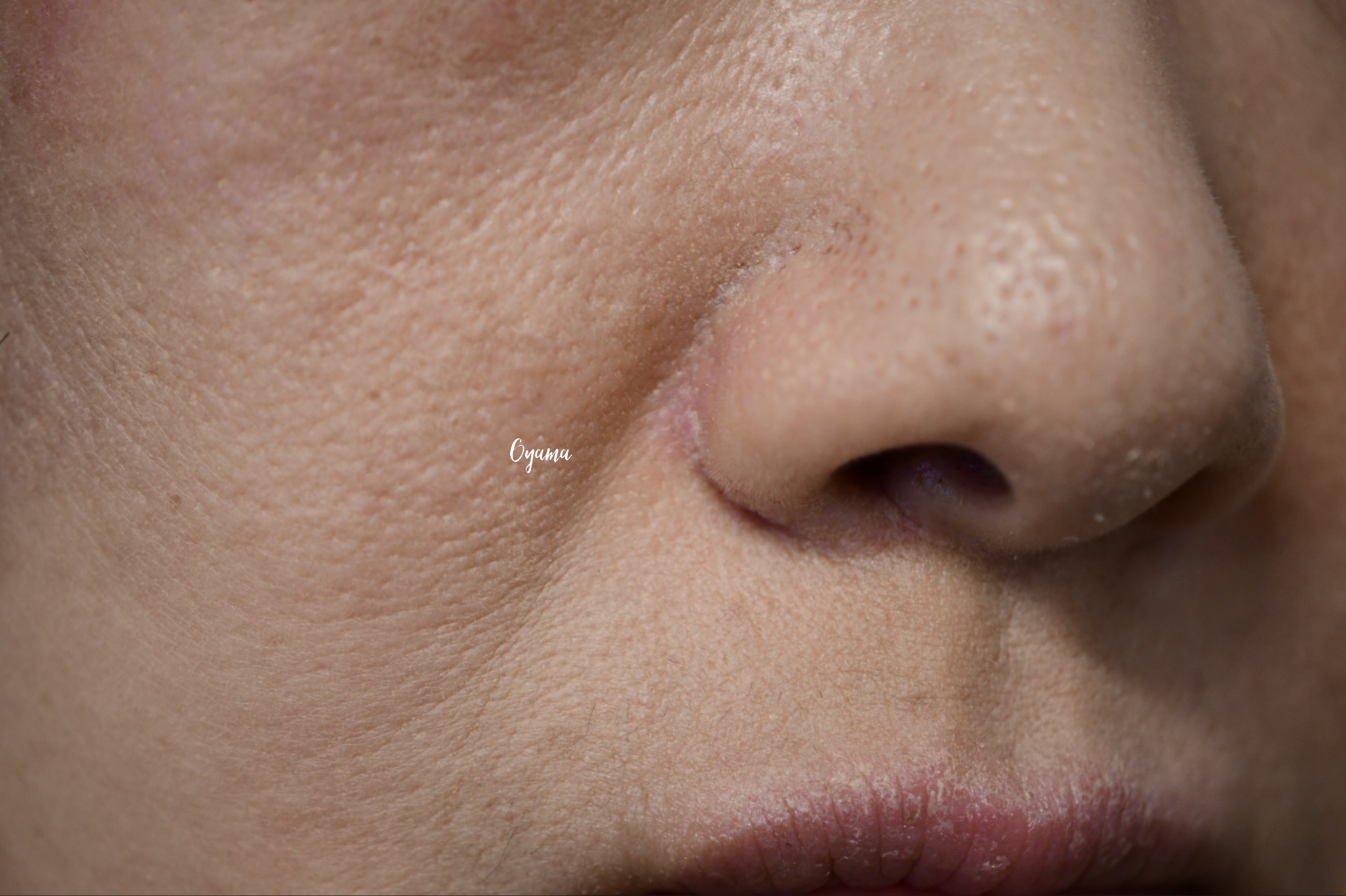 大きいほくろ除去