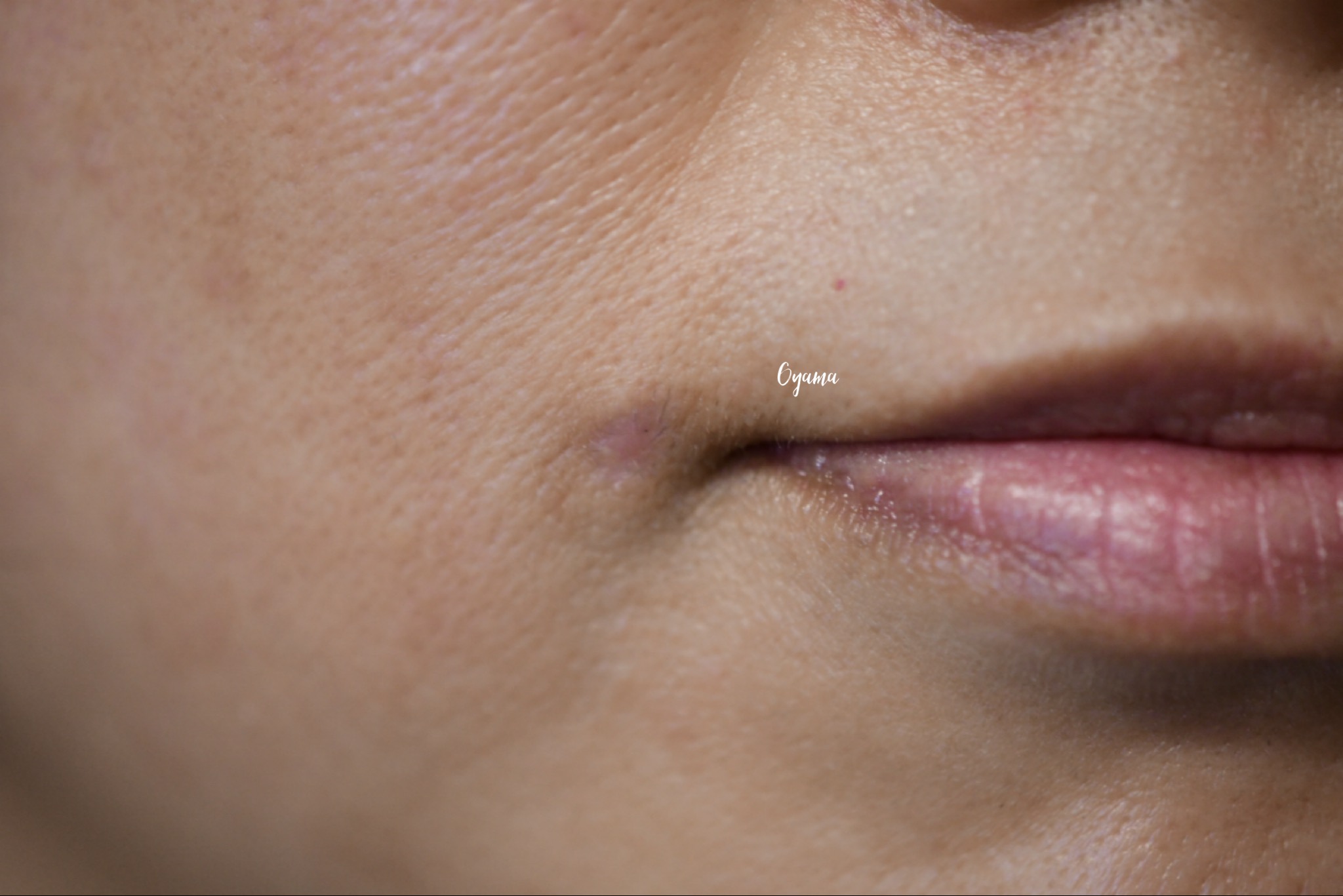 大きいほくろ除去