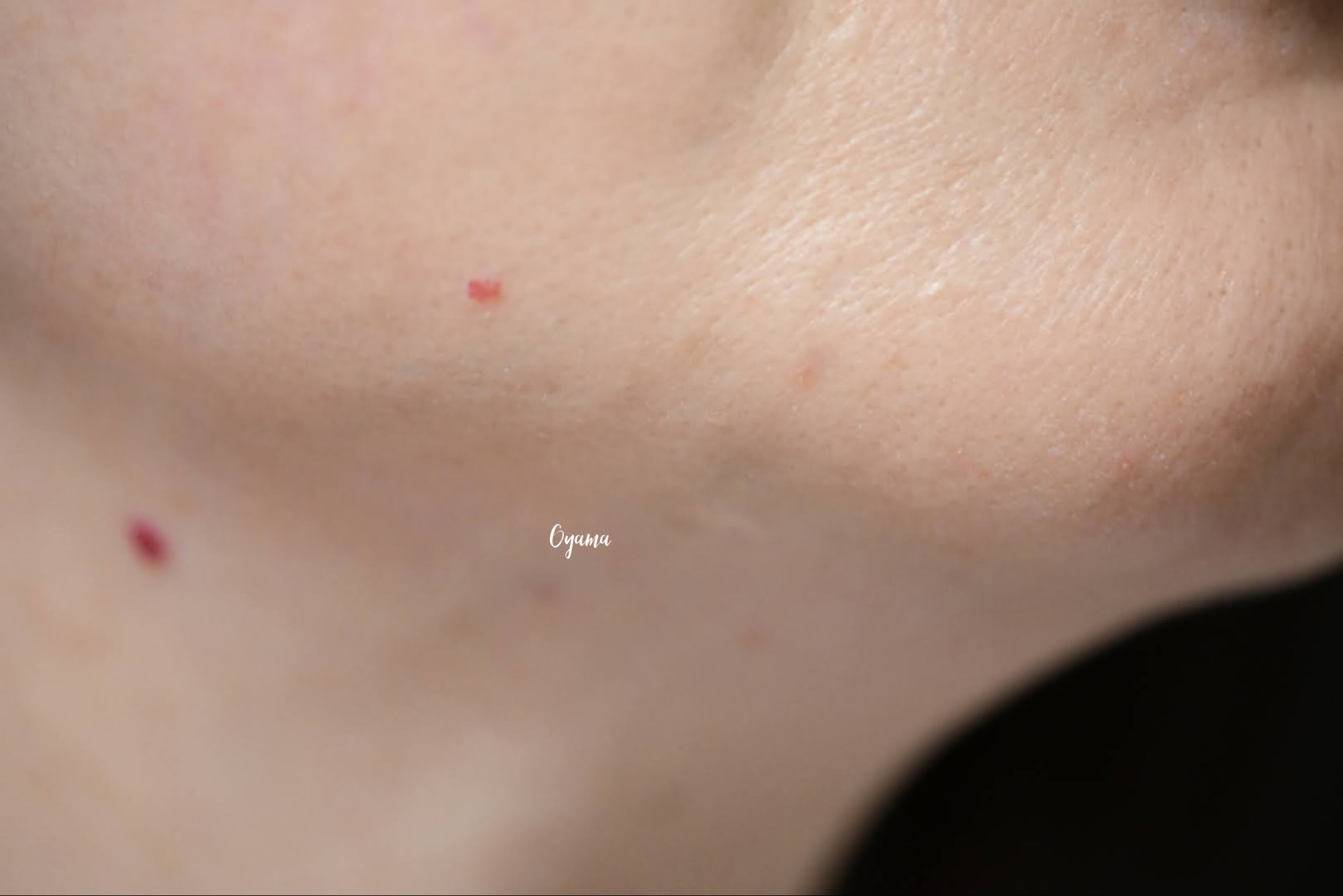 大きいほくろ除去