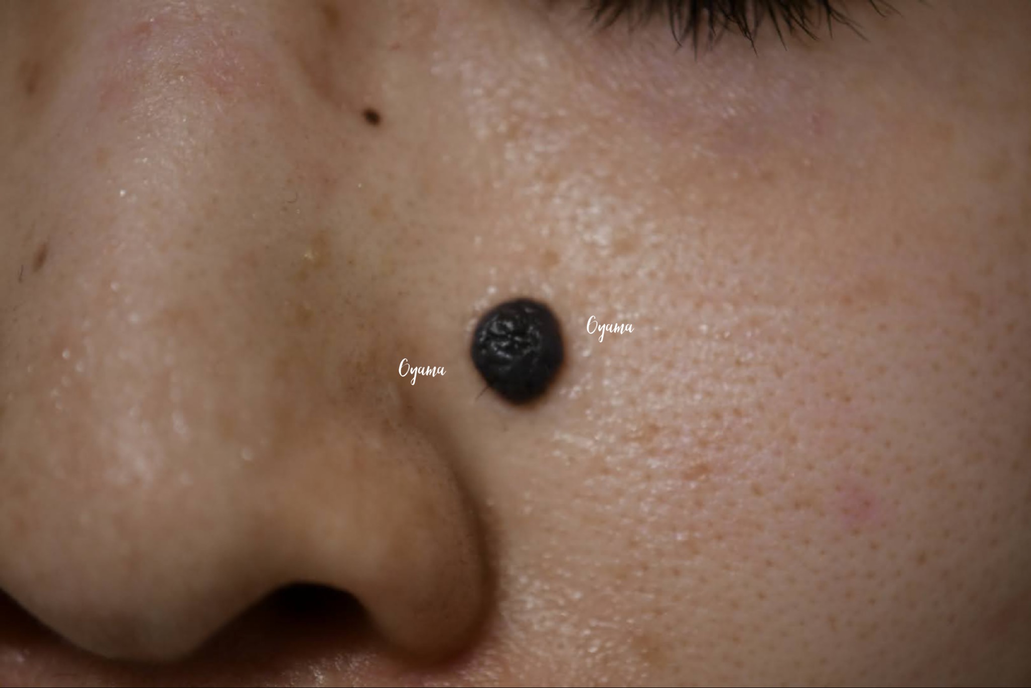 大きいほくろ除去