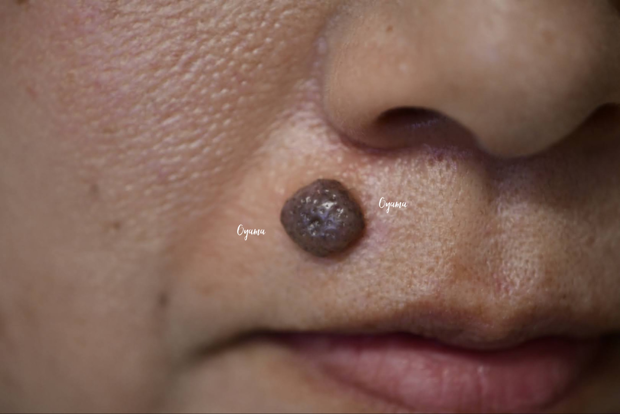 大きいほくろ除去