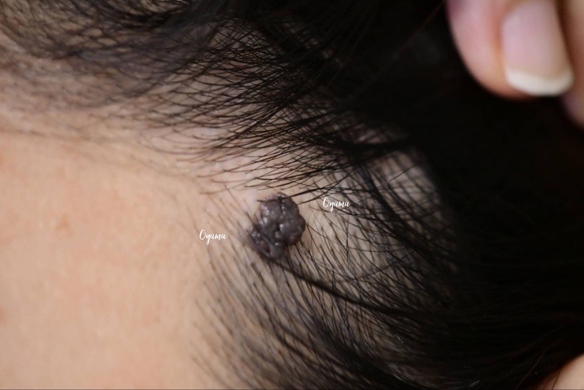 大きいほくろ除去