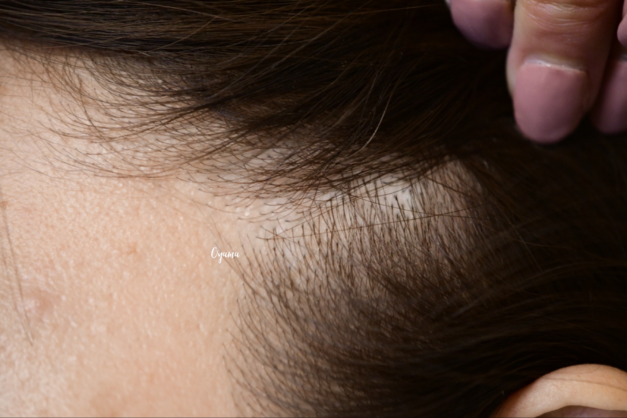 大きいほくろ除去